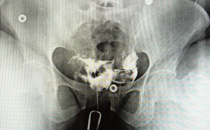 HSG