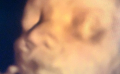 Gebelikte Ultrasonografi